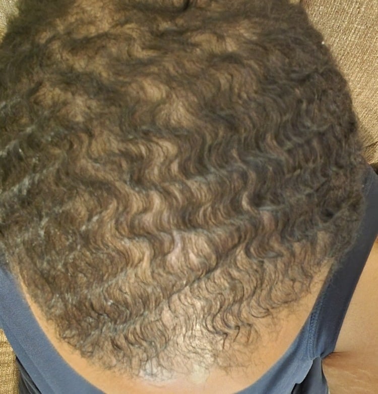 Cardon Real Hair Growth Results Before