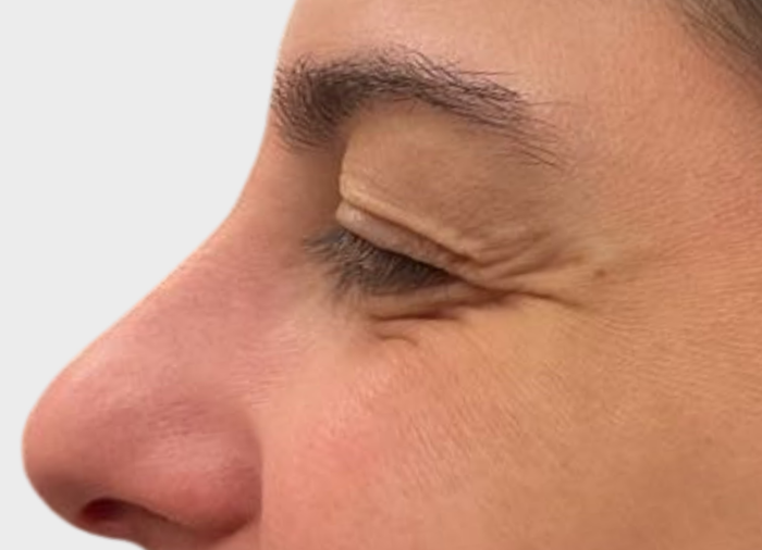 eye wrinkles treatments london dr david jack