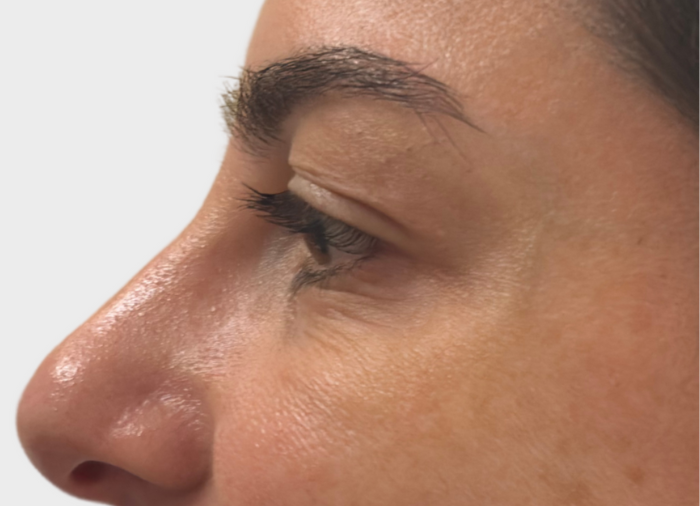 eye wrinkles treatments london dr david jack