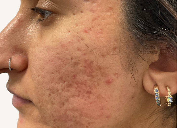 acne scarring treatments london