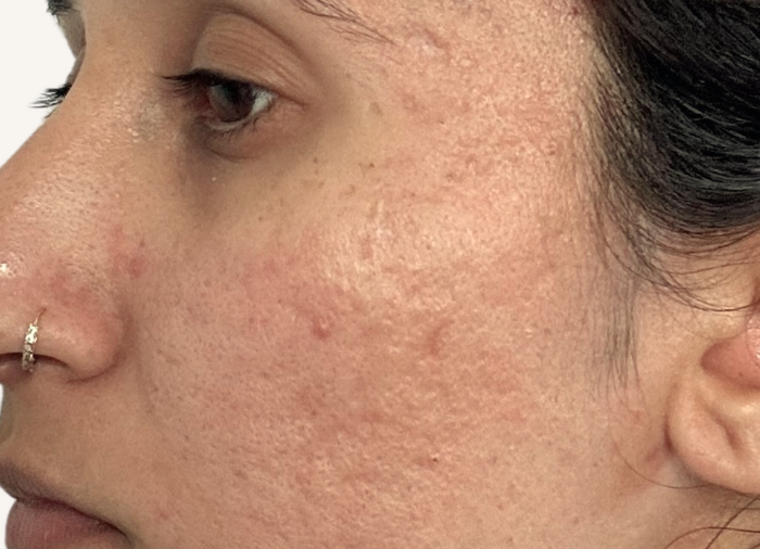 acne scarring treatments london