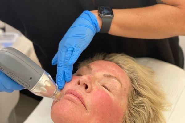 Radiofrequency Microneedling Featured Image