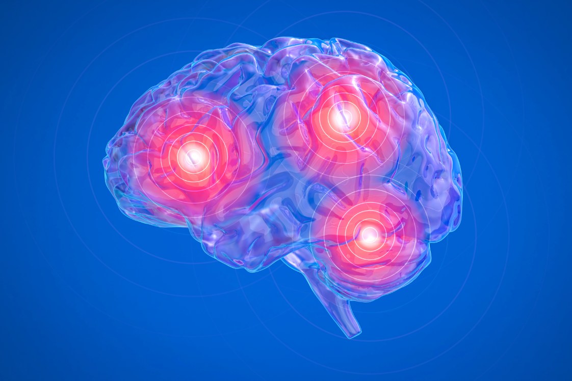 Visual of a brain with areas of affected by stress.