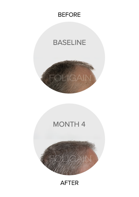 FOLIGAIN® Hair Health 
