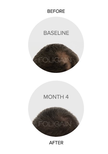 FOLIGAIN