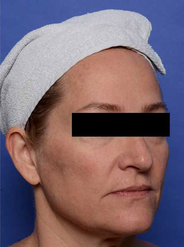 rhc-before-2-new