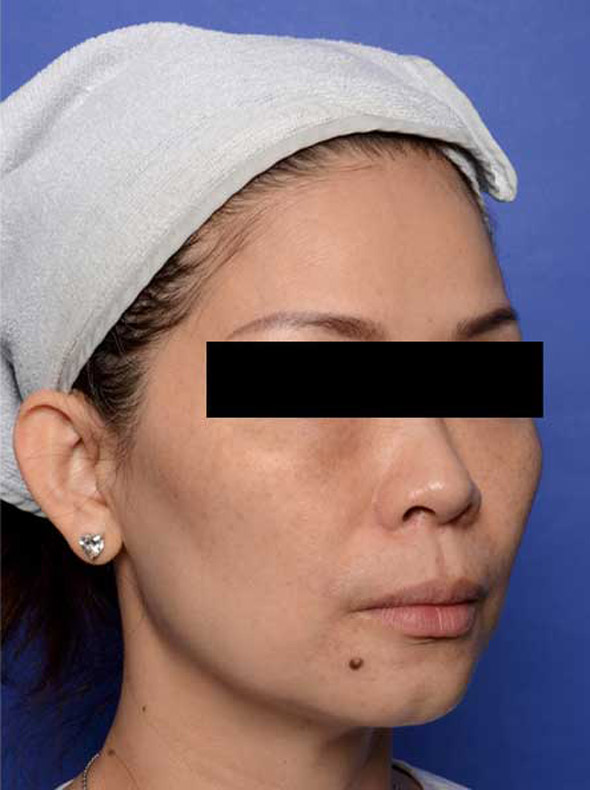 rhc-before-4-new