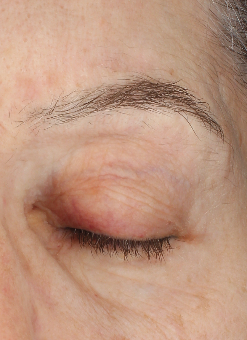 Vectra_After
