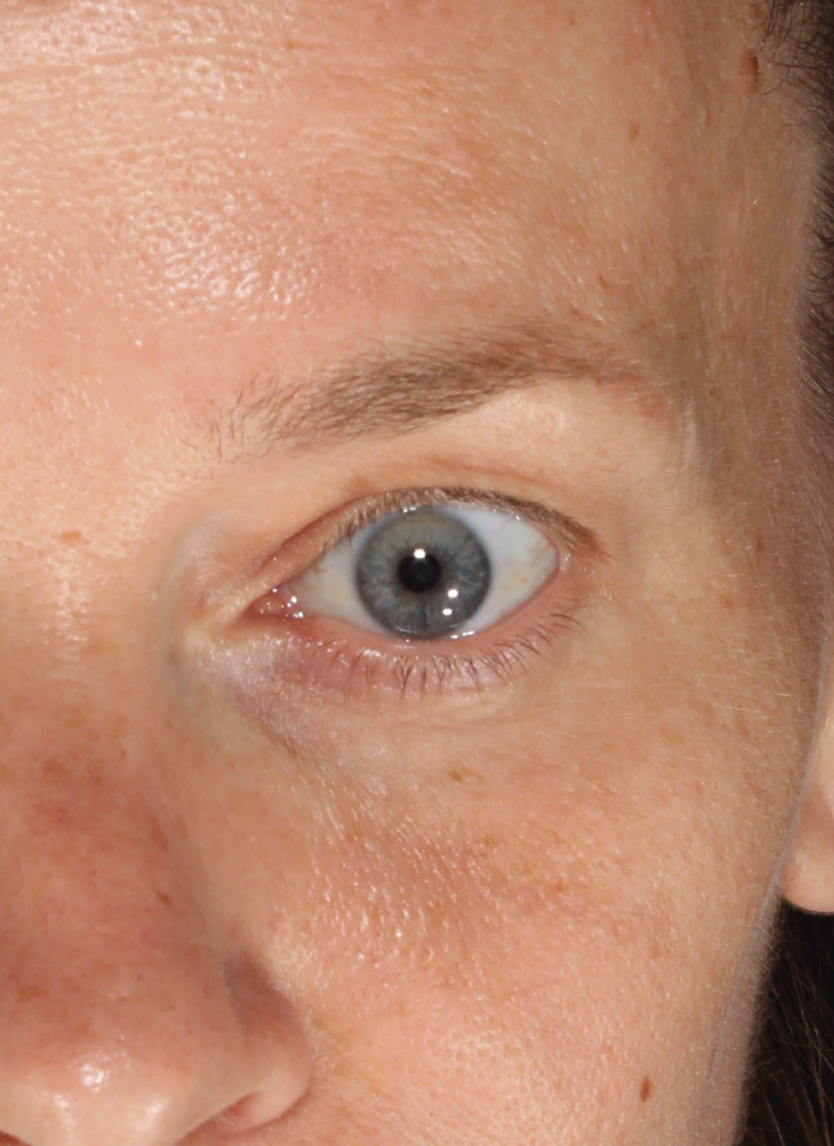 Visia_After