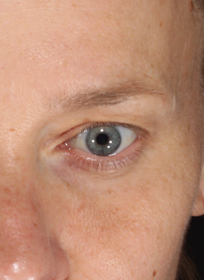 Visia_Before